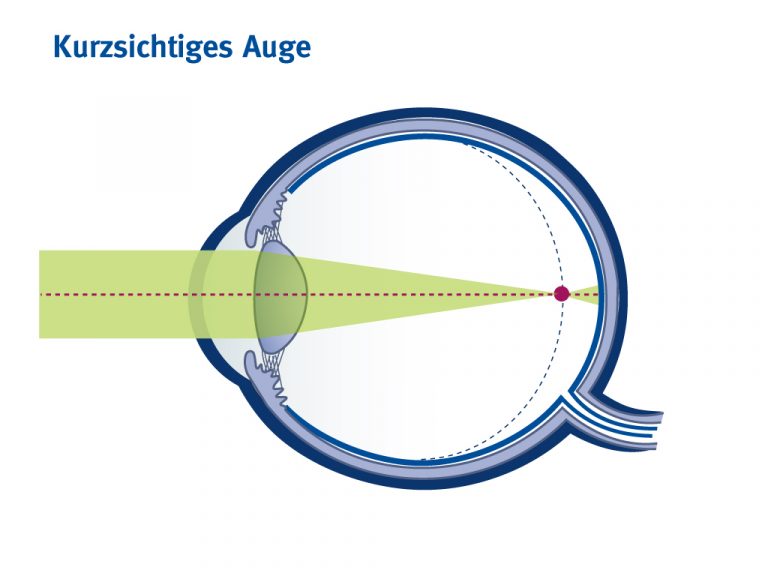Kurzsichtigkeit verbessern Augenarztpraxis Dr. Brodehl